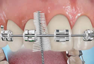 Perfect Smile ortho Proxabrush